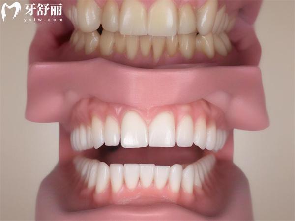 德韓口腔吸附性義齒價(jià)格表