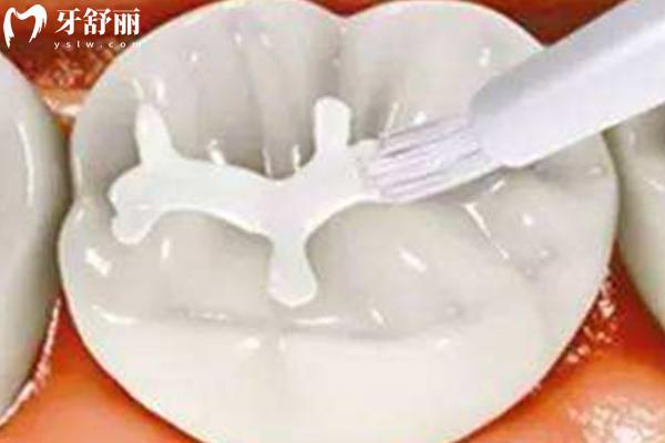納米樹(shù)脂補(bǔ)牙值不值得做