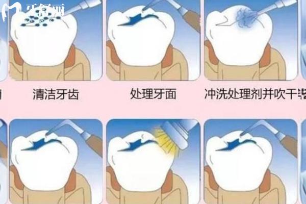 納米樹(shù)脂補(bǔ)牙值不值得做