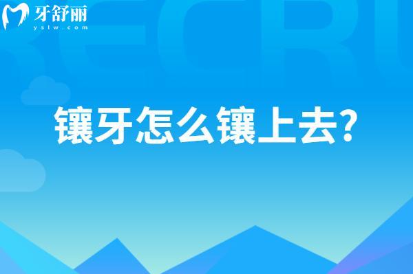 鑲牙怎么鑲上去?分享鑲牙過程圖解圖片大全(含活動牙/固定義齒/種植牙)