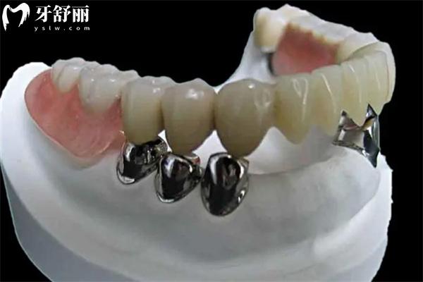 鑲牙怎么鑲上去?分享鑲牙過程圖解圖片大全(含活動牙/固定義齒/種植牙)