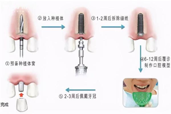 鑲牙怎么鑲上去?分享鑲牙過程圖解圖片大全(含活動牙/固定義齒/種植牙)
