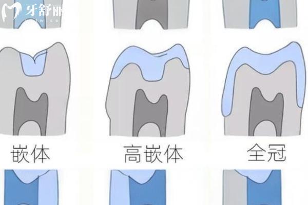 重慶補(bǔ)牙多少錢一顆？