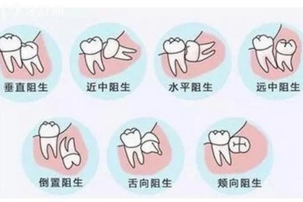 南寧哪里拔智齒便宜點(diǎn)
