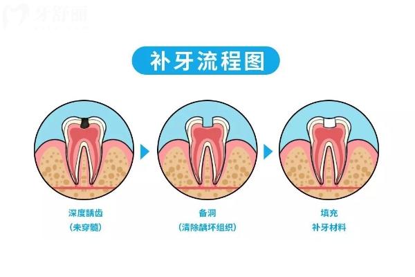 智齒蛀牙是拔好還是補？綜合考慮智齒的生長位置、蛀牙程度、身體狀況等