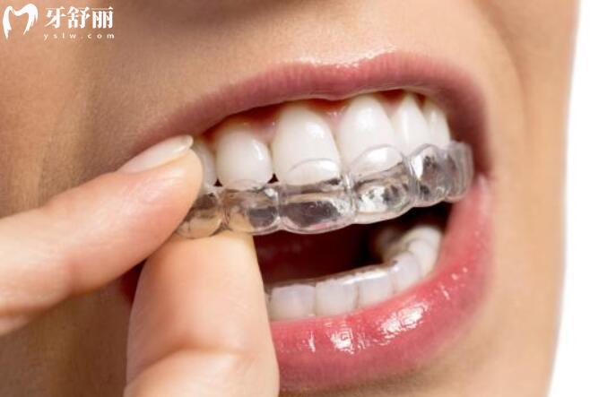 深度對(duì)比：舌側(cè)矯正與隱適美在美觀性、舒適度及適用人群上的核心差異