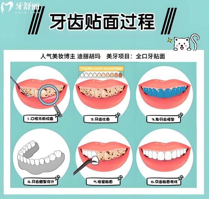 牙貼面制作過(guò)程
