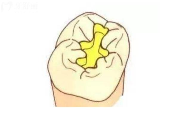 補牙與嵌體哪一個更牢靠？補牙與嵌體優(yōu)略勢對比