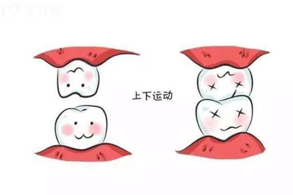 牙齒過度磨損照片