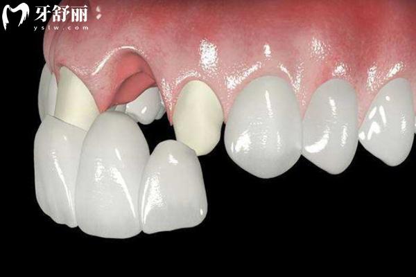 愛迪特VS愛爾創(chuàng)全瓷牙哪個(gè)質(zhì)量好