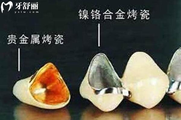 烤瓷牙