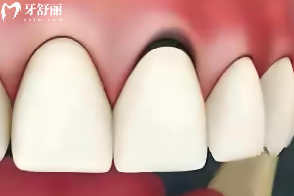 烤瓷牙多少錢一顆價格表2025