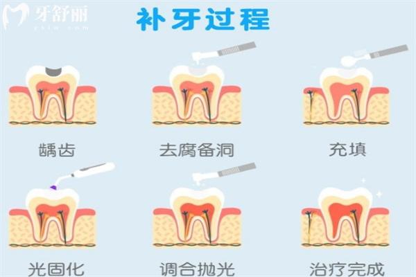 怎么判斷補(bǔ)牙是否成功了?關(guān)注補(bǔ)牙后這些注意事項(xiàng)及細(xì)節(jié)即可判斷!