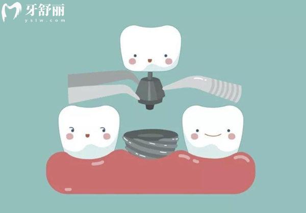沈陽(yáng)口腔醫(yī)院種植牙多少錢一顆