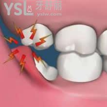 拔掉智齒有什么危害！