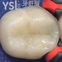 天津愛齒口腔樹脂補(bǔ)牙雙11優(yōu)惠價格