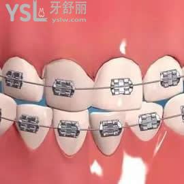 昆明雅度口腔傳統(tǒng)金屬托槽矯正雙11優(yōu)惠價格