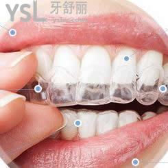 昆明雅度口腔隱形矯正牙齒雙11優(yōu)惠價格