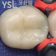 當(dāng)雙十二遇上廣州圣貝口腔8周年慶-進(jìn)口樹脂補(bǔ)牙只需138元起