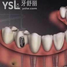 北京中諾口腔醫(yī)院全口種植牙費(fèi)用