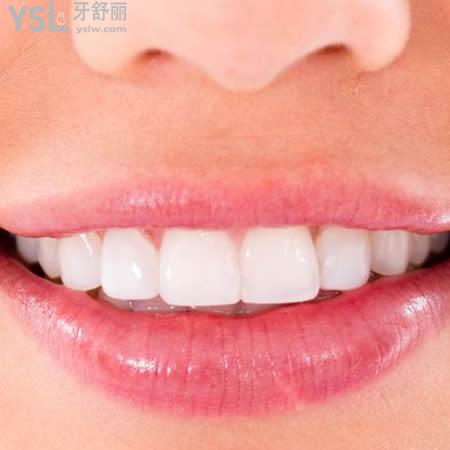 昆明雅度口腔美加超薄瓷貼面收費標準