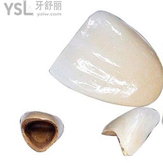 北京維樂(lè)口腔鈷鉻合金烤瓷牙價(jià)格貴嗎？