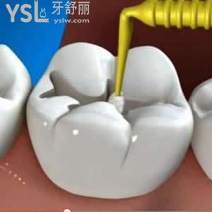 北京維樂口腔成人3m樹脂補牙價格