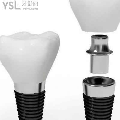 深圳格倫菲爾口腔美國3i種植牙收費價格