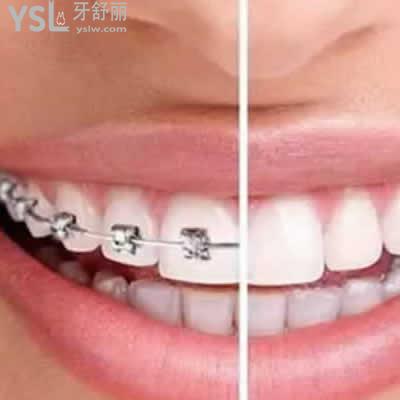 深圳格倫菲爾口腔傳統(tǒng)金屬托槽牙齒矯正價(jià)格貴嗎？