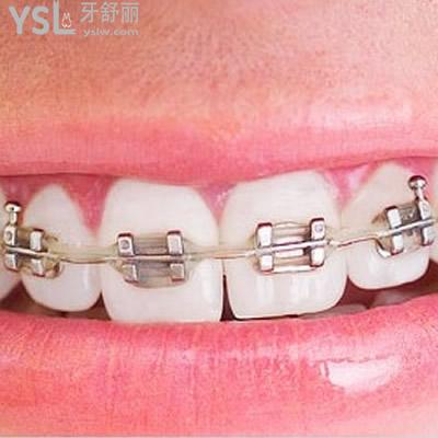 深圳正夫口腔金屬托槽牙齒矯正費(fèi)用