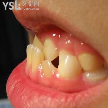深圳正夫口腔成人地包天牙齒矯正價(jià)格