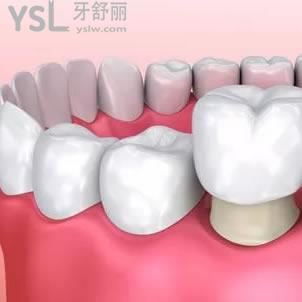 深圳正夫口腔鈷鉻合金烤瓷牙價(jià)格表