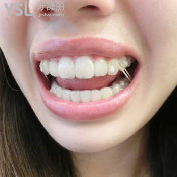 深圳雷蕾口腔隱適美（invisalign）矯正價(jià)格會(huì)不會(huì)很貴呢？