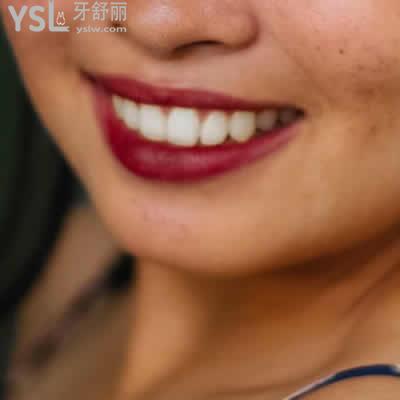 昆明長鵬口腔威蘭德全瓷牙價格表及優(yōu)點