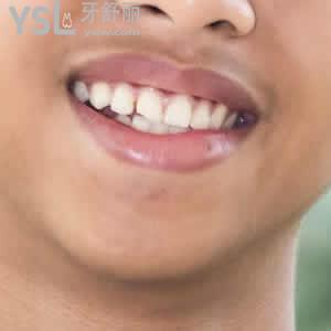 昆明長鵬口腔德國VOCO納米樹脂補(bǔ)牙價(jià)格表