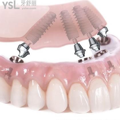 山東日照凱思口腔ALL-ON-4瑞典N(xiāo)obel半口種植多少錢(qián)？