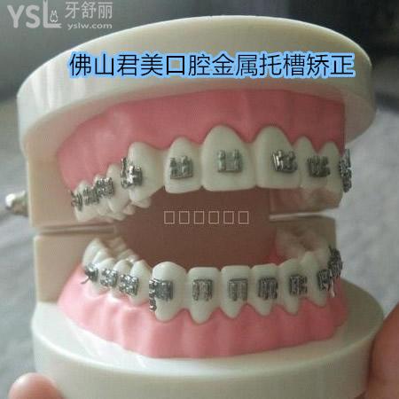 佛山春芽口腔怎么樣？國產(chǎn)金屬托槽矯正價(jià)格來襲