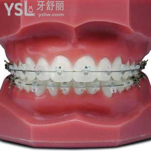 深圳世紀河山口腔隱形托槽牙齒矯正價格