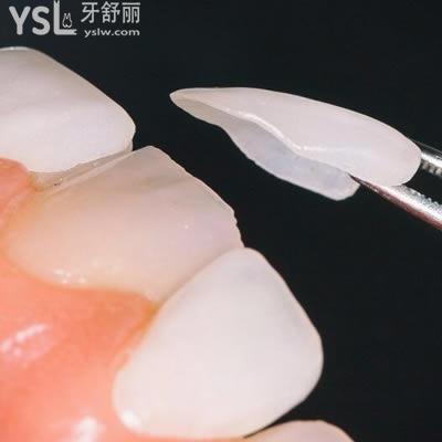 包頭植諾口腔怎么樣？包頭植諾口腔超薄瓷貼面價格貴嗎？