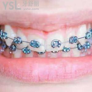 西安中諾口腔醫(yī)院金屬牙齒矯正價(jià)目表
