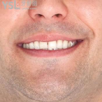 揭秘長(zhǎng)安金典口腔韓國(guó)登騰種植牙價(jià)格表及顧客評(píng)價(jià)