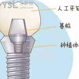 鄭州唯美口腔種植牙多少錢一顆