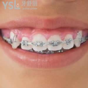 鄭州唯美口腔傳統(tǒng)金屬托槽牙齒矯正價(jià)格表