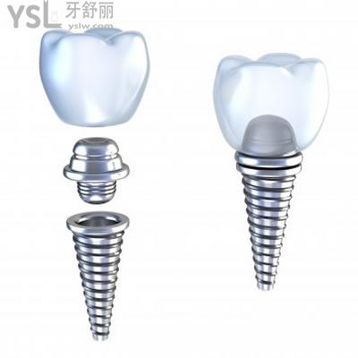 廣州雅度口腔看牙貴不貴？告知廣州雅度口腔德國(guó)ANKYLOS種植系統(tǒng)價(jià)格表