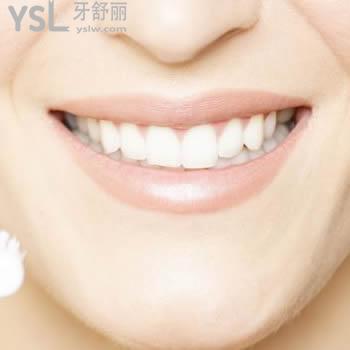 提供一份廣州雅度口腔進(jìn)口3m  p60樹脂補(bǔ)牙價格表及顧客評價