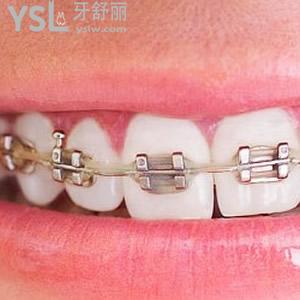 廣州廣大口腔金屬自鎖托槽牙齒矯正收費怎么樣