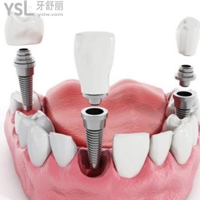 深圳質(zhì)美口腔韓國登騰種植體包干價(jià)貴不？