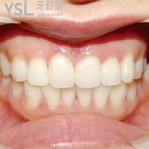 上海悅康口腔坑人嗎？全瓷牙價格有活動好劃算。
