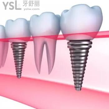 沈陽盛大口腔韓國進(jìn)口植體全包價格表