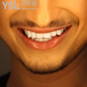 上海永華口腔門(mén)診部收費(fèi)標(biāo)準(zhǔn)隱適美隱形矯正多少錢(qián)？